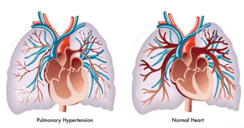 легочная-гипертензия